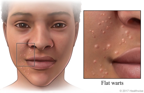 warts on face