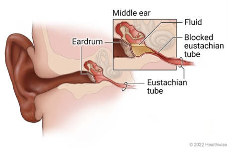 tubes in ears