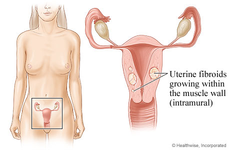 Location of uterus and ovaries, with detail of fibroid growing in uterine wall.