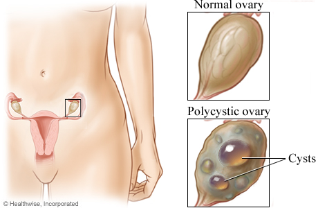 pcos ovary removal