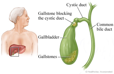 gallstones in poop