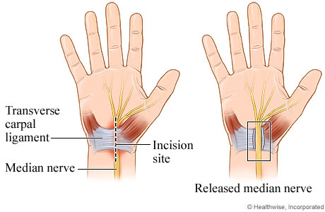 Guide, Physical Therapy Guide to Carpal Tunnel Syndrome