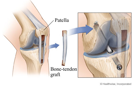Patellar Tendon Repair Reconstruction, Knee Doctor