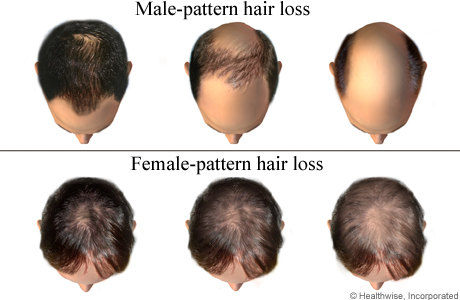 What commonly causes alopecia areata
