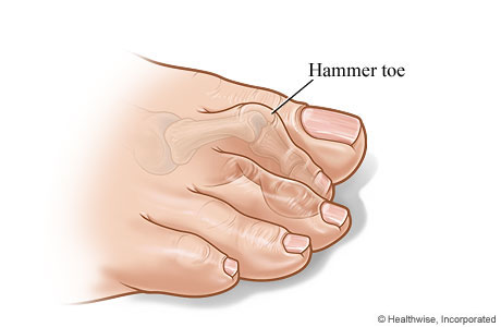 Hammertoe Correction (Discharge Care)