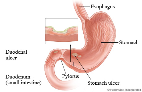 small intestine ulcer treatment