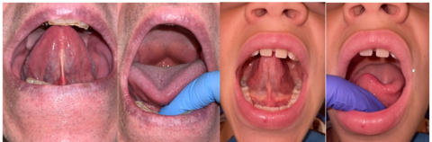 xamples of a test you can try at-home to see if you have a restricted tongue tie