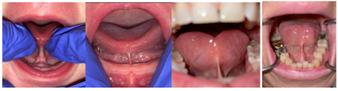 Examples of various tongue ties in babies and older ages